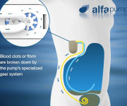 Primi impianti italiani dell'Alfapump system prodotti da Sequana Medical