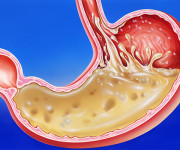 Stomach acid reflux