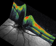 tomografia a coerenza ottica