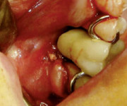 Difetti della coagulazione e odontoiatria -  focus sul paziente emofilico