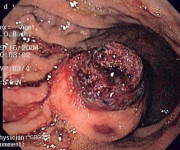 GIST, tumori stromali gastrointestinali