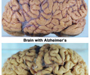 Alzheimer cervello
