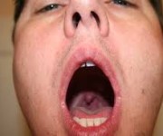 Antibiotici e mal di gola